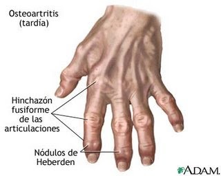 Enfermedades de osteoartritis
