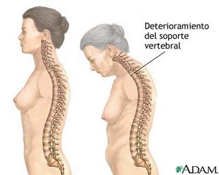 Encorvamientode la columna vertebral